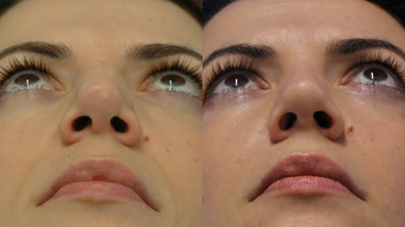 Avaliando a elegibilidade para o procedimento de rinoplastia preservadora, com Alan Landecker 2 Alan Landecker